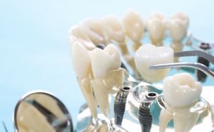 松山區植牙推薦