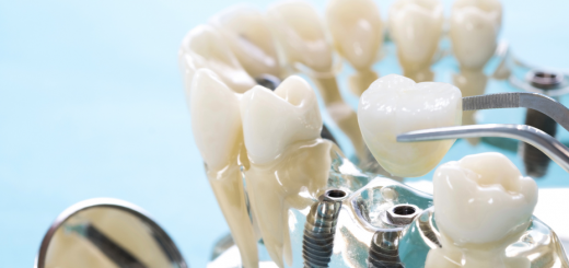 松山區植牙推薦